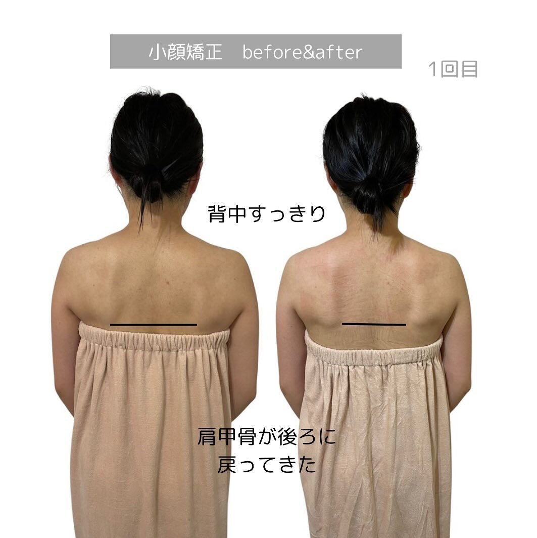 小顔矯正