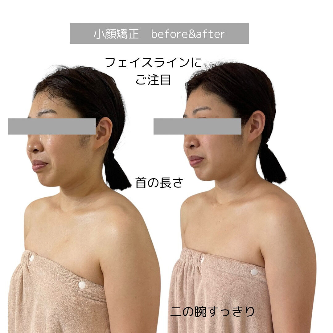 肩の丸まりとフェイスライン
