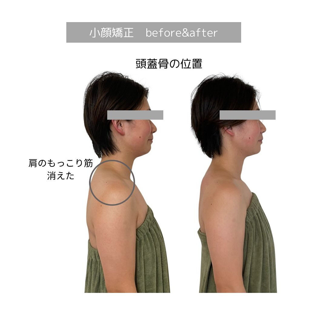 フェイスラインのもたつき悩んでませんか？